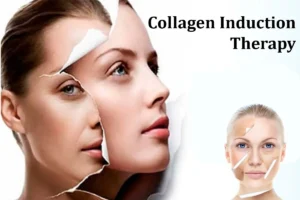 Collegen induction therapy (CIT)