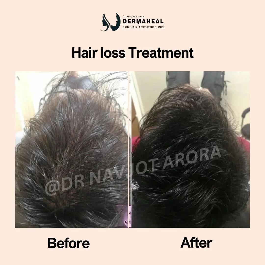 Best Hair Transplant Dwarka 2026 Guide