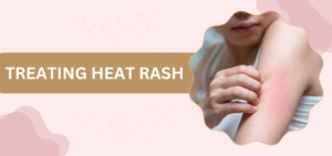 Treating Heat Rash