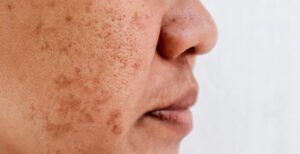 DERMATOLOGIST-APPROVED MELASMA TREATMENTS FOR FLAWLESS SKIN