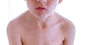 ECZEMA TREATMENTS FOR CHILDREN: SAFE AND EFFECTIVE APPROACHES