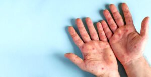 HOW STRESS CAN TRIGGER ECZEMA, AND HOW TO AVOID A FLARE UP