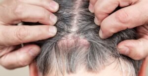 HOW TO MANAGE SCALP PSORIASIS: TIPS FOR HEALTHY HAIR AND SKIN