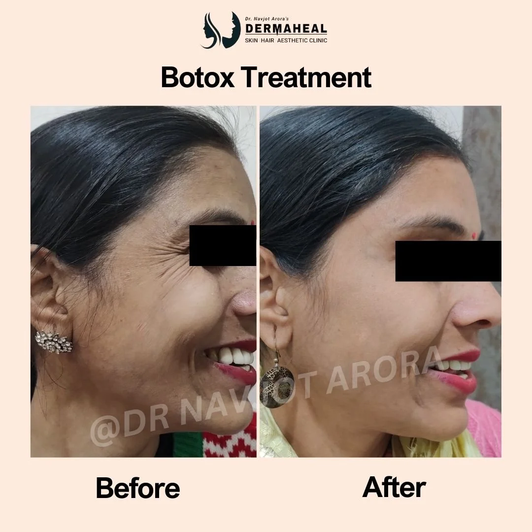 Botox Treatment in Dwarka: 5 Reasons It Works Wonders