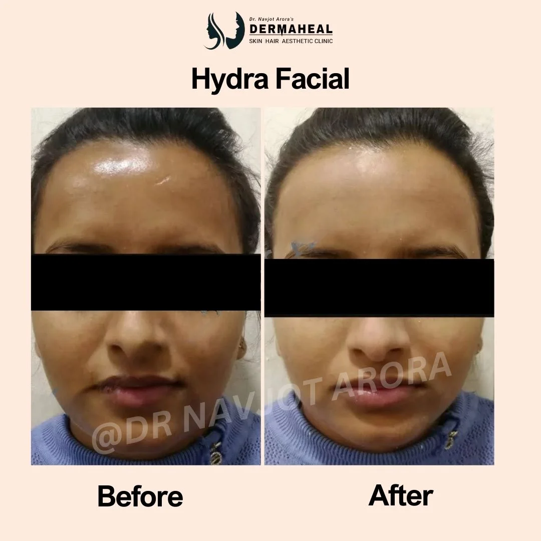 #1 Hydrafacial in Dwarka, New Delhi | Trusted Glow Experts at Dermaheal