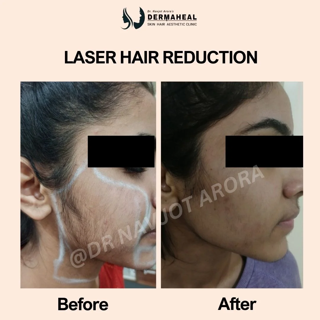 Laser Hair Reduction – 5 Powerful Benefits, Procedure & What to Expect