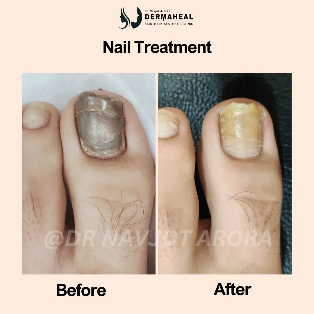 Nail Surgery in Dwarka – 5 Common Nail Conditions Treated at Dermaheal