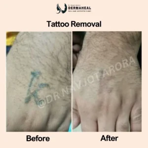 Tattoo Removal in Dwarka – 5 Reasons to Choose Laser Removal at Dermaheal