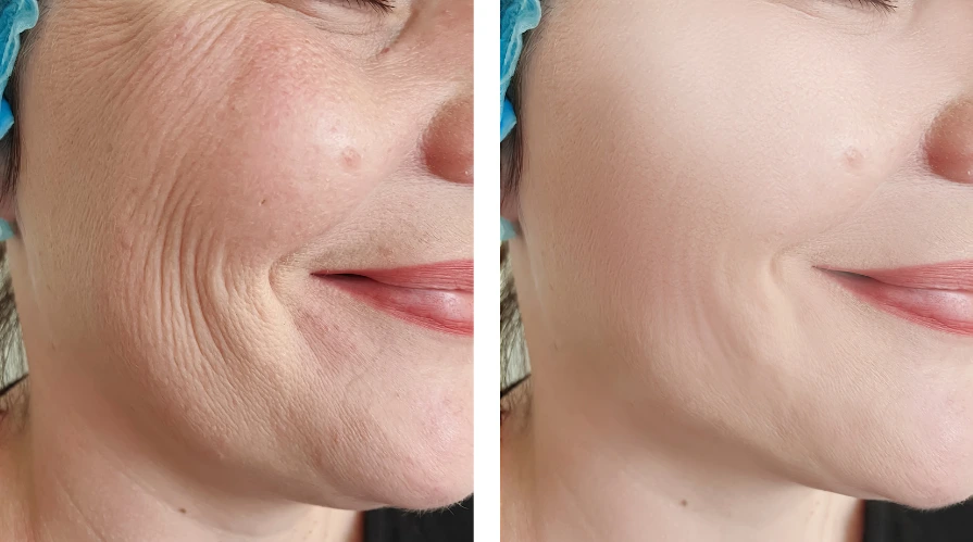 Botox treatment in Delhi at Dermaheal Clinic