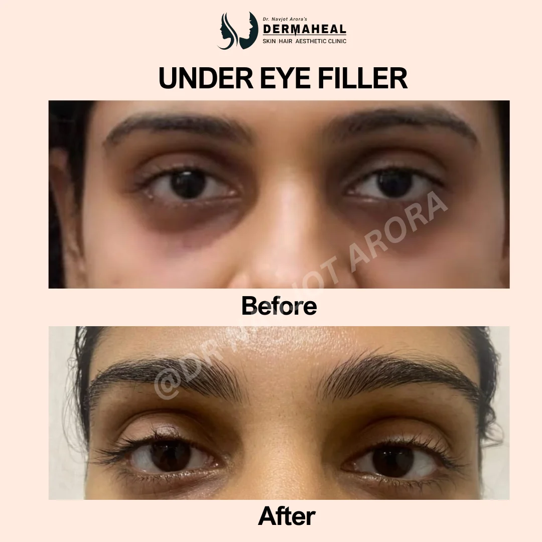 Dermal Fillers in Dwarka – 7 Proven Benefits of Non-Surgical Facial Rejuvenation at Dermaheal