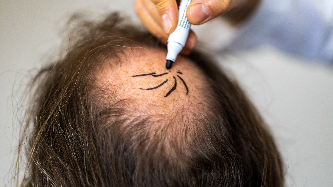 The Truth About Hair Transplant Scars: What You Really Need to Know About FUE, FUT & Healing
