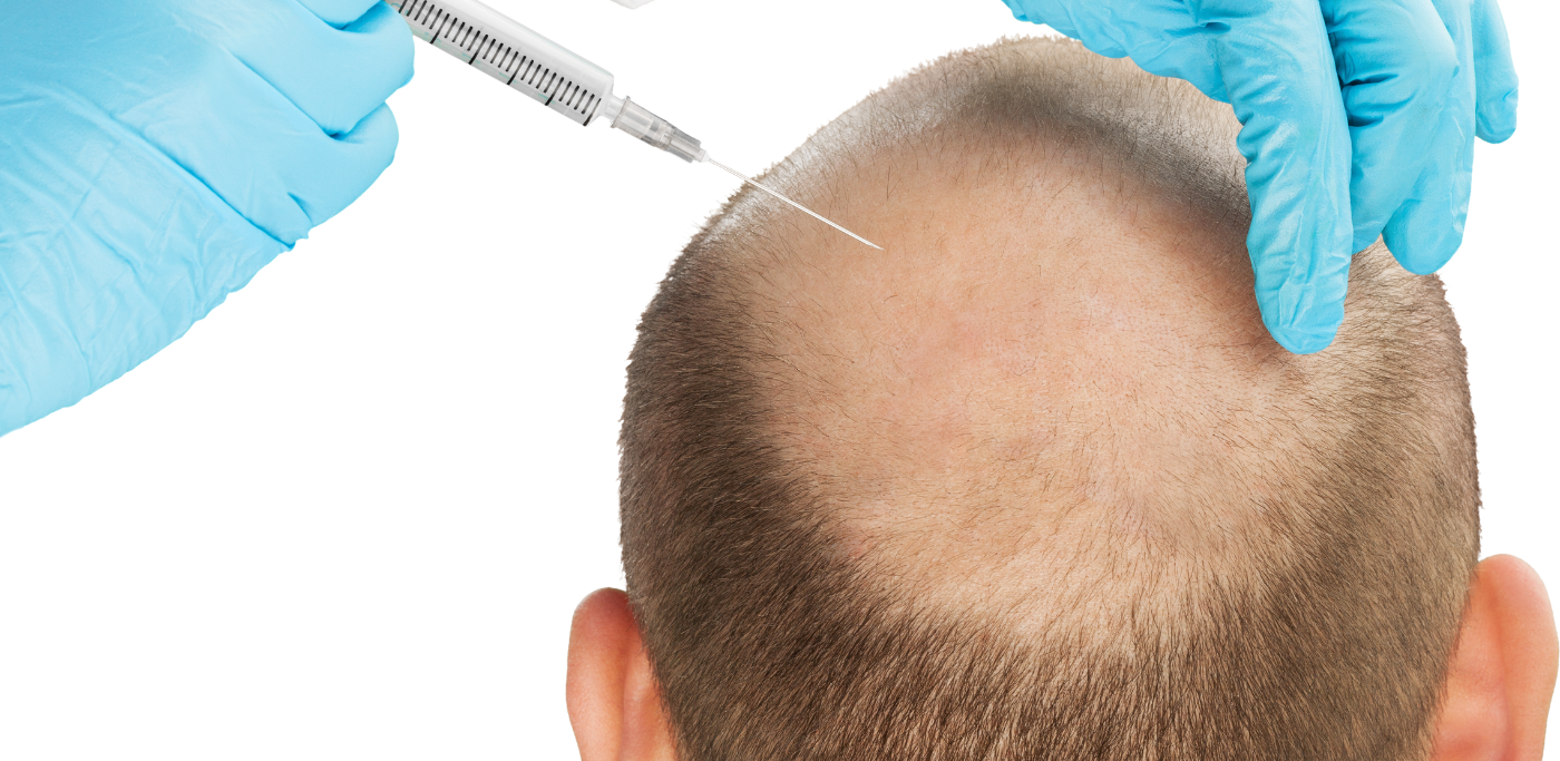 Best Hair Transplant Hospital in Delhi – Dermaheal Clinic, Dwarka