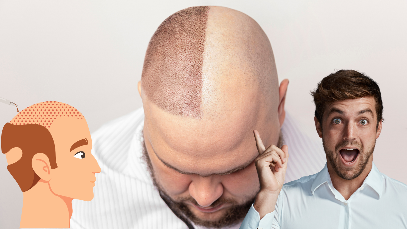 Losing Hair? Here’s Everything You Need to Know About Hair Transplantation (From the Experts in Dwarka)