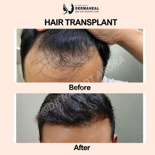 Best Hair Transplant Clinic in Dwarka – Your Trusted Destination for Hair Restoration