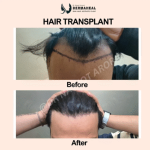 benefits of hair transplant in Dwarka