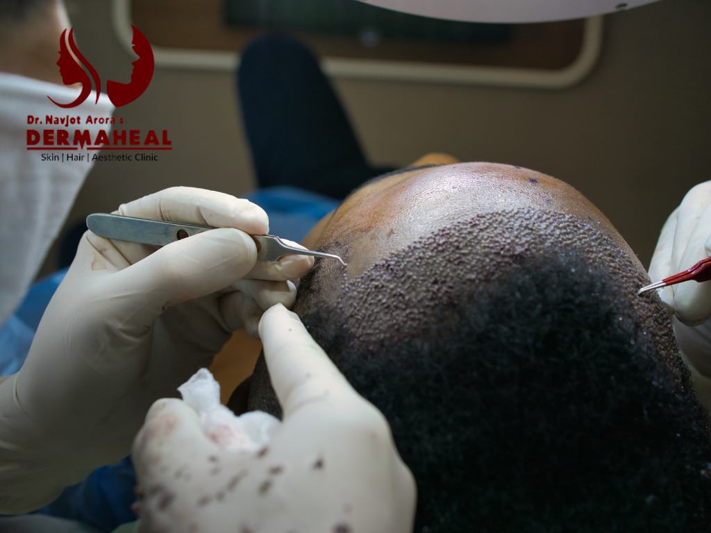 Hair Transplant Myths Debunked: What You Need to Know from the Experts at Dermaheal Clinic