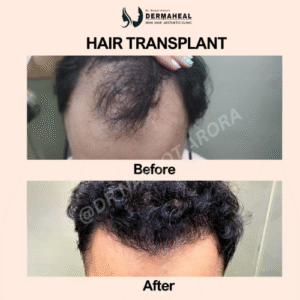 Illustration of key benefits of hair transplant at Dermaheal Clinic Dwarka including natural results, confidence boost, and expert dermatologist care