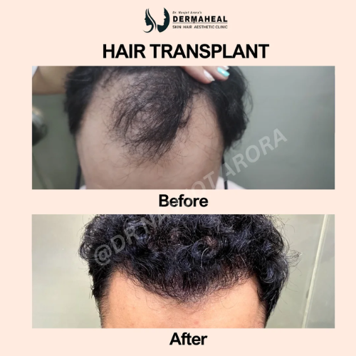 Discover the Benefits of Hair Transplant at Dermaheal Clinic