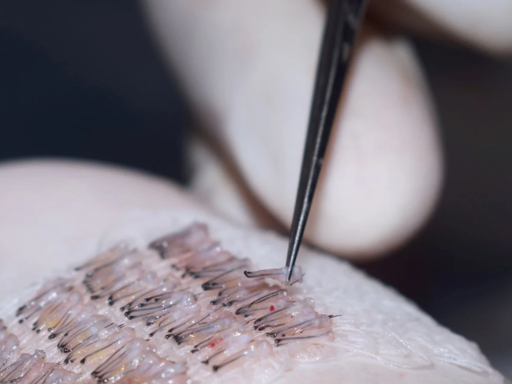 Hair Transplant in Delhi – Regain Your Confidence with Dr. Navjot Arora’s Dermaheal