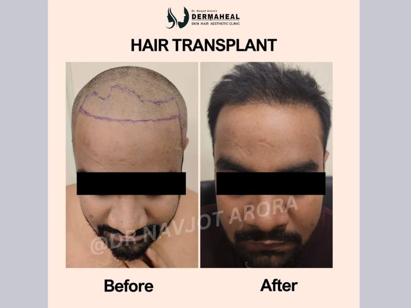 Transform Your Look with the Best Hair Transplant Solutions in Dwarka – Expert Care by Dr. Navjot Arora