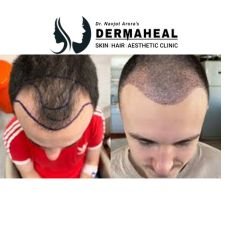 Best Hair Transplant Clinic in Dwarka | Expert Care by Dr. Navjot Arora