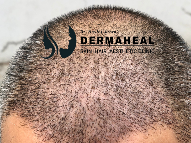 Unlocking the Future of Hair Transplant: Dermaheal Dwarka Leads with Next-Gen Results