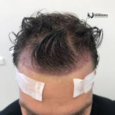 Top Hair Transplant Clinic in Dwarka | Trusted by Dr. Navjot Arora