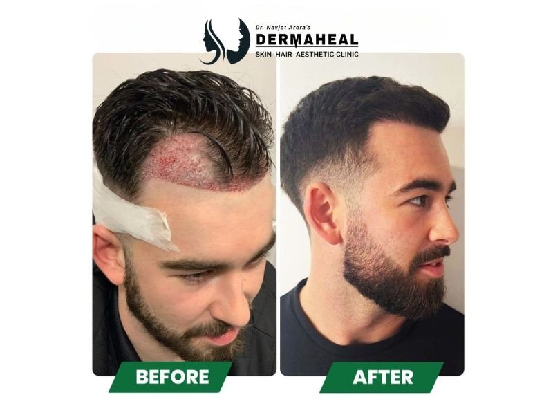 Best Hair Transplant in Dwarka: Why Dermaheal Stands Apart