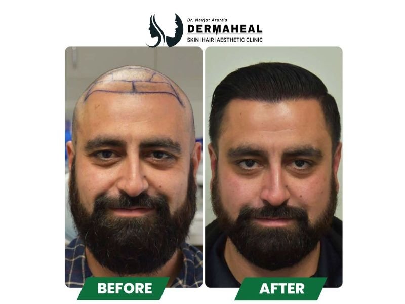 Restore Your Confidence with the Best Hair Transplant in Dwarka at Dermaheal