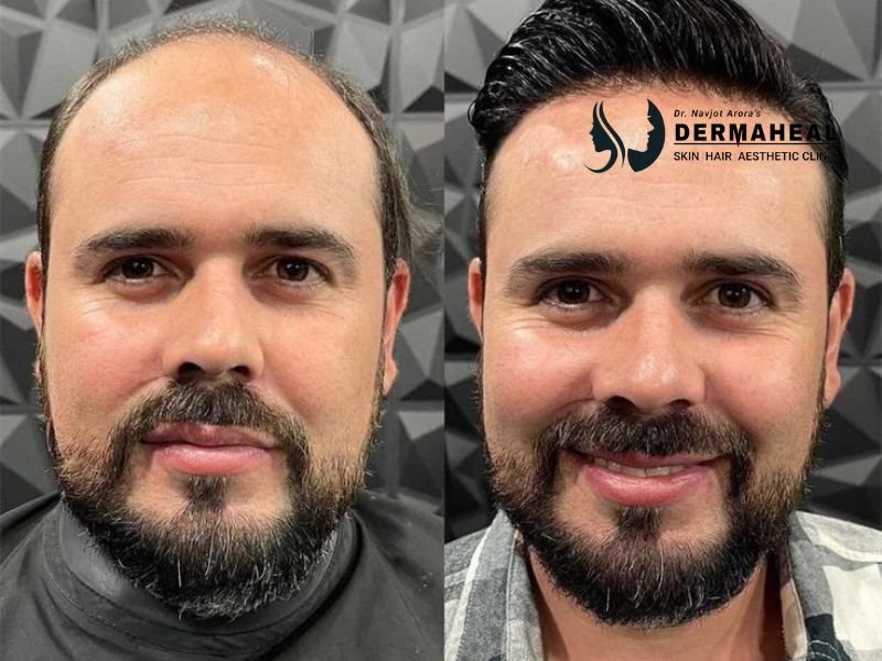 Hair Transplant in Dwarka – Restore Your Hair, Restore Your Confidence with Dermaheal