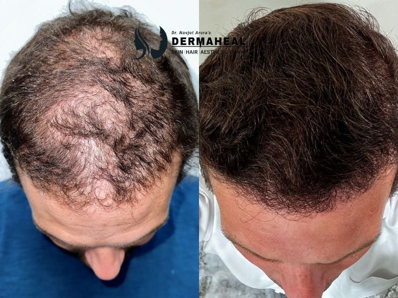 Expert Hair Transplant Solutions in Dwarka: Why Dermaheal Clinic is the Trusted Choice