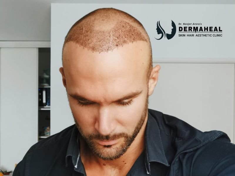 Restore Your Hair with Expert Hair Transplant in Dwarka