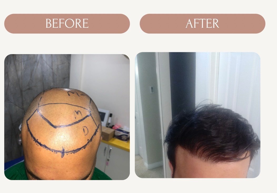 Hair Transplant in Dwarka | Trusted Expert Care by Dermaheal Clinic