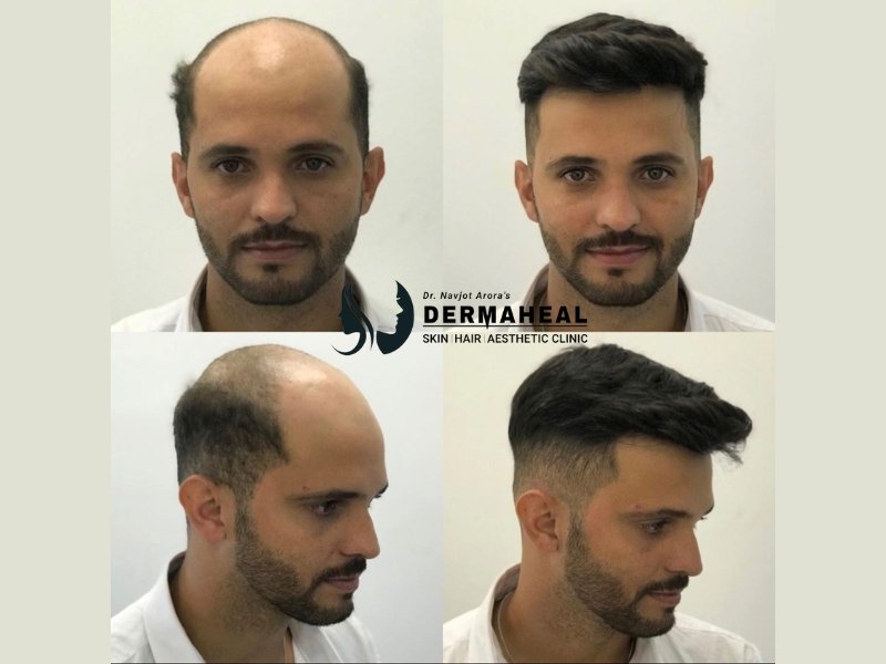 Best Hair Transplant Clinic in Dwarka – Restore Your Confidence