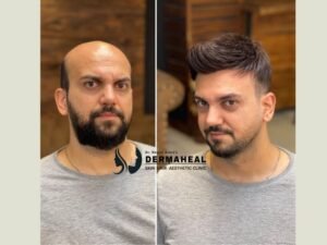 Best Hair Transplant Clinic in Dwarka – Restore Your Natural Hairline