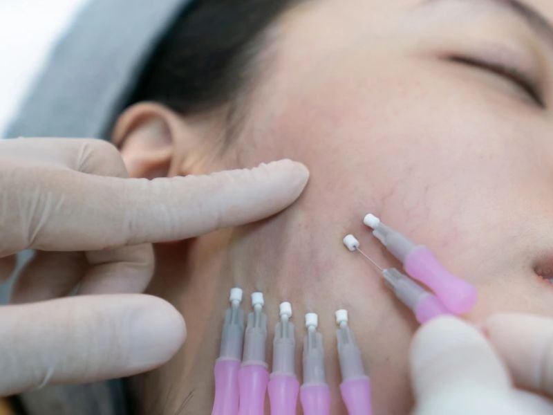 Thread Lifting in Dwarka – Lift, Tighten & Rejuvenate Your Skin