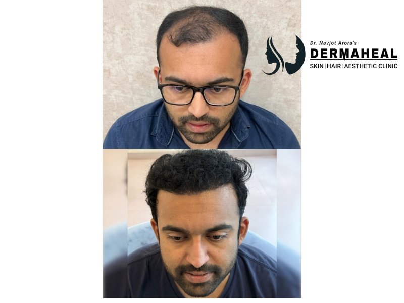 Best Hair Transplant Clinic in Dwarka | Expert Care at Dermaheal