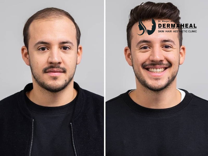 Hair Transplant in Dwarka | Expert Hair Restoration Clinic