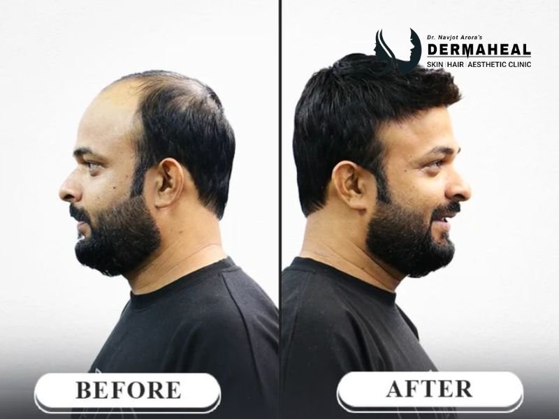 Hair Transplant in Dwarka: Your Trusted Solution for Natural Hair Restoration