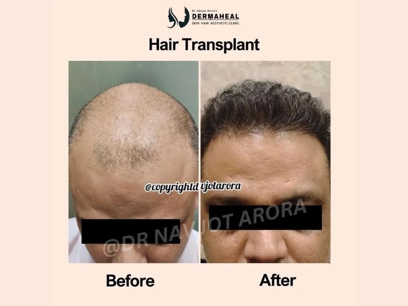 Hair Transplant in Dwarka: Regain Confidence with Expert Care at Dermaheal Clinic