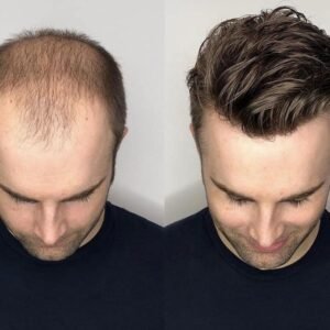 Best Hair Transplant Clinic in Dwarka – Dermaheal Skin & Hair Clinic