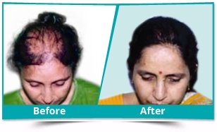Hair Transplant in Dwarka | Expert Care at Dermaheal Clinic