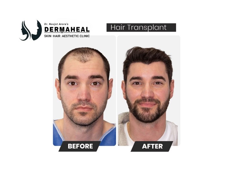 Hair Transplant Recovery in Dwarka – Expert Aftercare & Fast Results