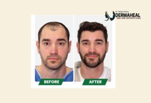 Best Hair Transplant Clinic in Dwarka: 7 Top Reasons Dermaheal