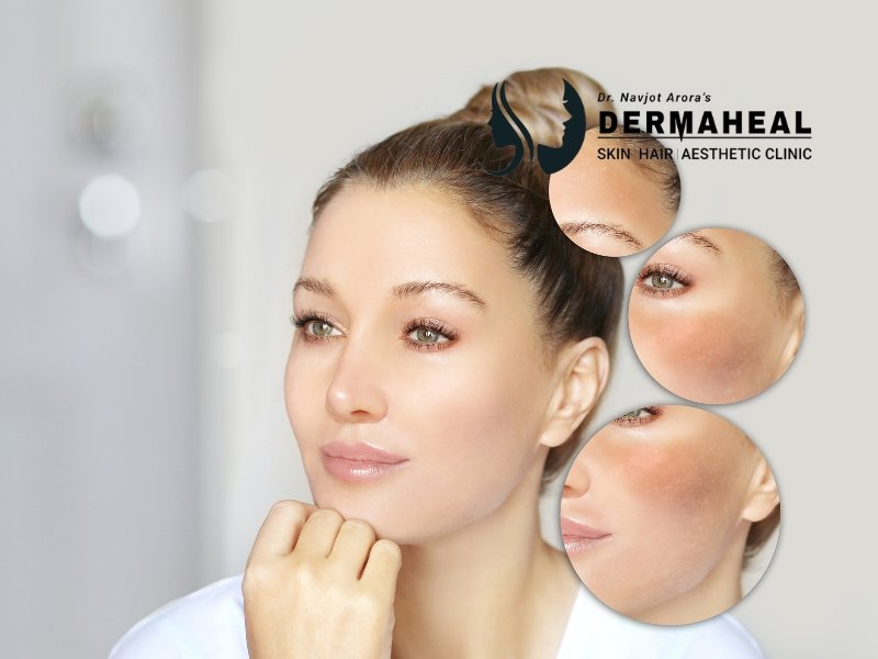 7 Proven Melasma Treatment in Dwarka Solutions