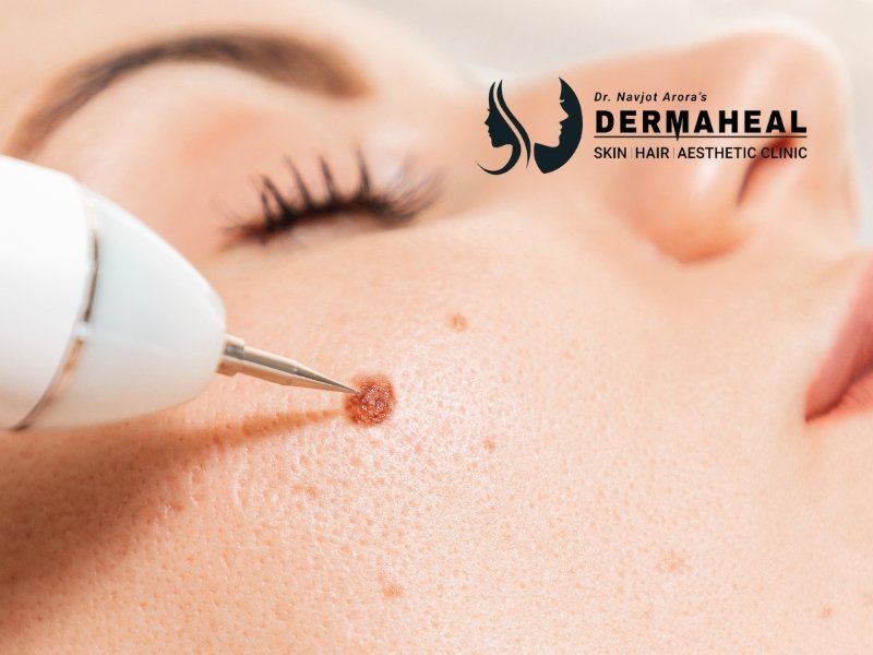 wart removal in Dwarka