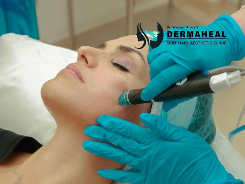 hydrafacial near me Dwarka