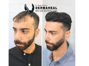 7 Best Hair Transplant in Dwarka Clinics (Natural Results 2025)