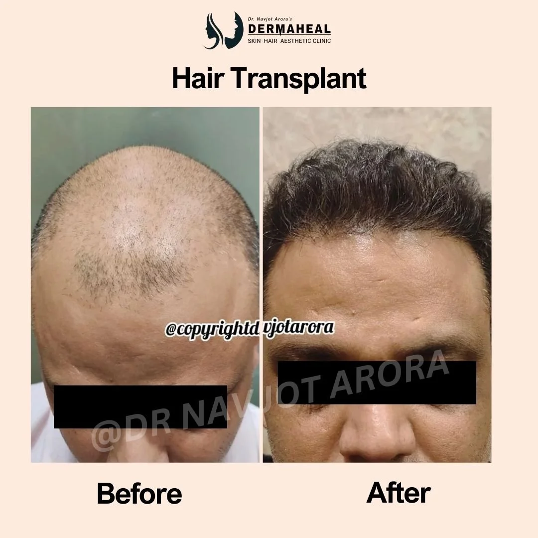 Best Hair Transplant Clinic in Dwarka: Top 5 Treatments