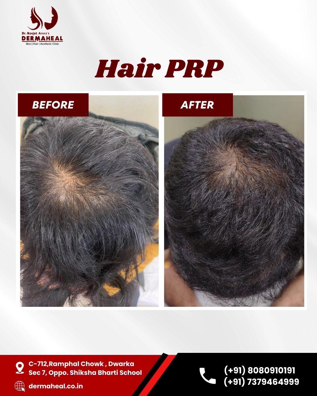  Top 7 Hair Loss Treatments in Dwarka: PRP & Transplant Guide